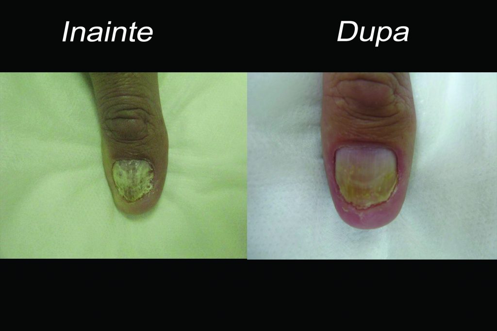 Patologia unghiei – decolorarea ei și alte anomalii